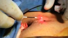 Pilonidal Sinus Laser Treatment